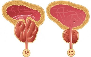 How Prostalix treats prostatitis before and after treatment