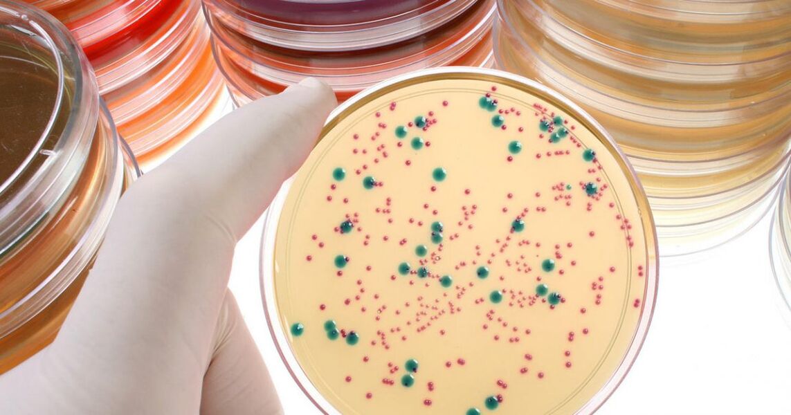 Bacterial chronic prostatitis is detected by analysis of urine and prostate secretions