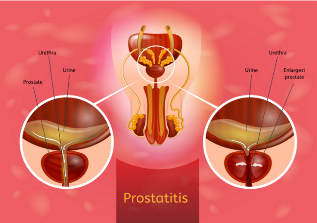 prostatitis