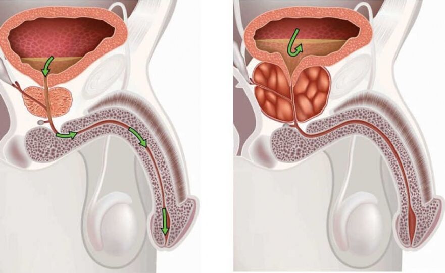 healthy and weak prostate in men