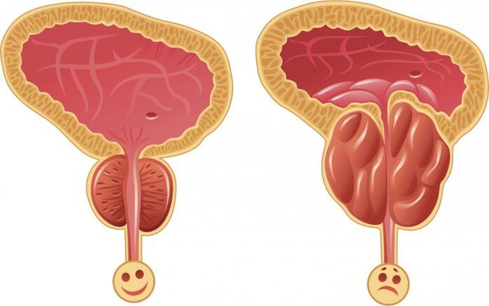 healthy and inflammation of the prostate with prostatitis