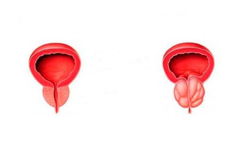 healthy and inflammatory prostate with prostatitis