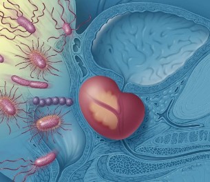 The inflammation of the prostate gland